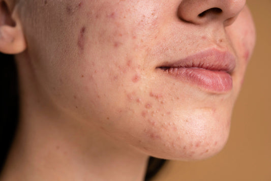 Noncomedogenic Oils: List Of Oils, Effects on Face, and Skin Care