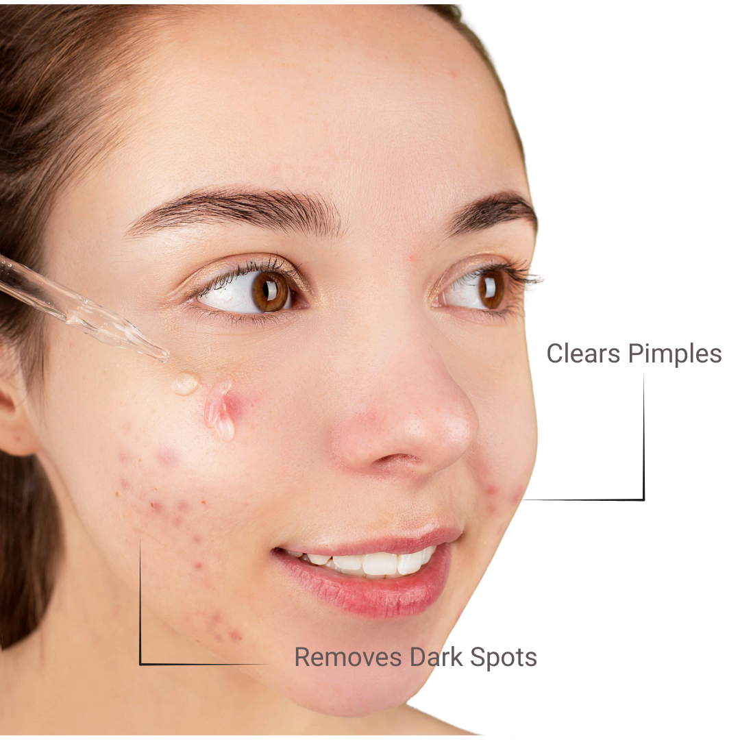 Best Acne serum in Pakistan