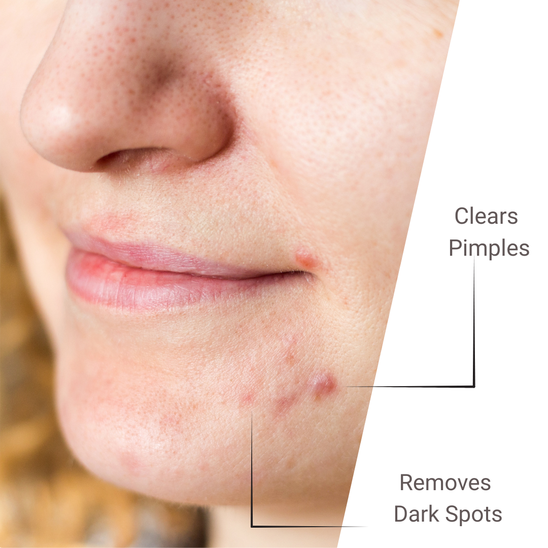 Anti Acne Serum