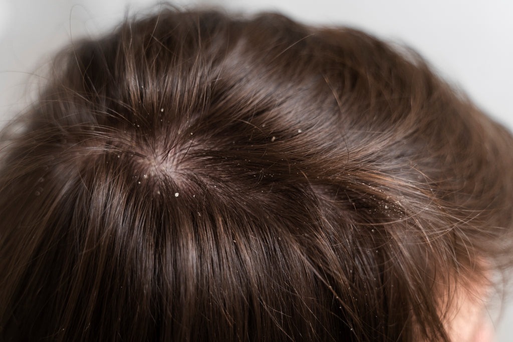 How to cure Dandruff at home?