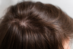 How to cure Dandruff at home?