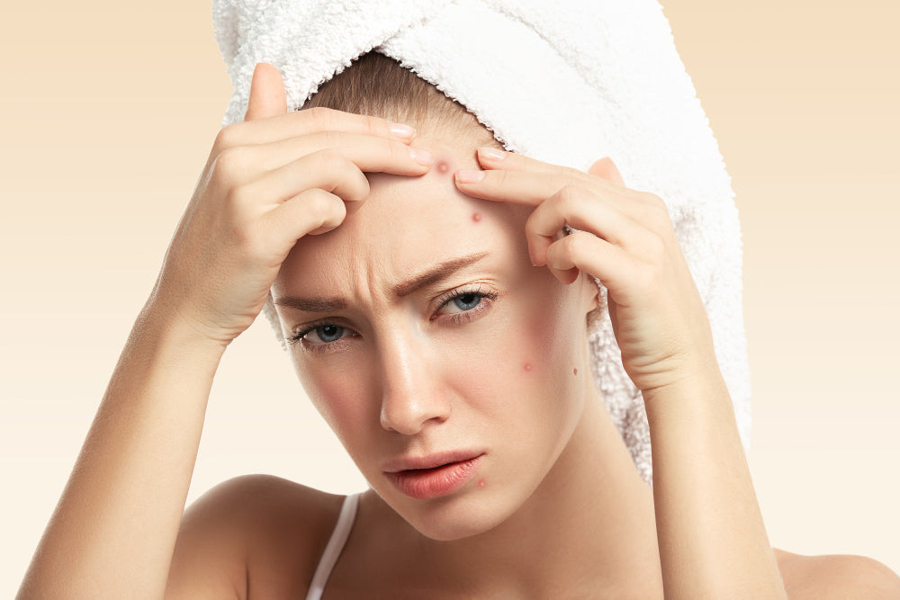 How Stress Affects Acne: The Comprehensive Guide