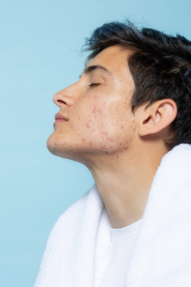 Best Essential Oils for Acne, According to Science: Your Ultimate Guide