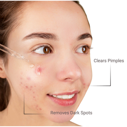 Best Acne serum in Pakistan